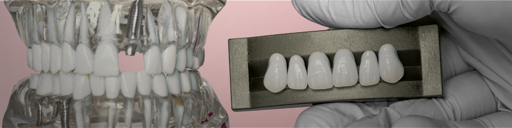 Model showing types of dental implants at manhattan arch collective