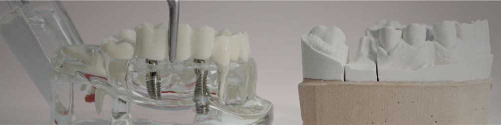 bone grafts for tooth implants model