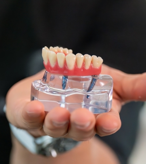 All on four dental implants being shown to a patient using a model