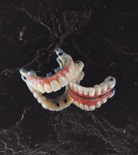Dental model showing All-on-X dental implant restoration