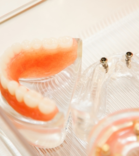 Full Arch Dental Implants in Manhattan being shown on a model