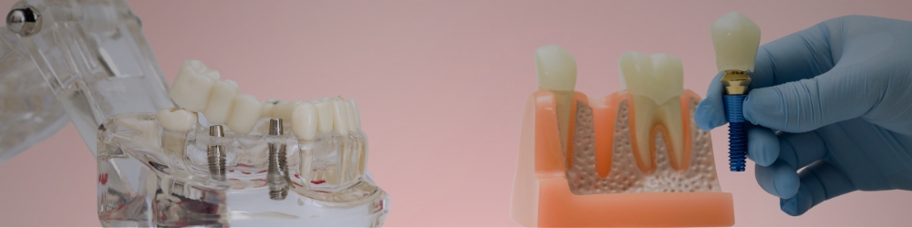 Model depicting how long do dental implants last