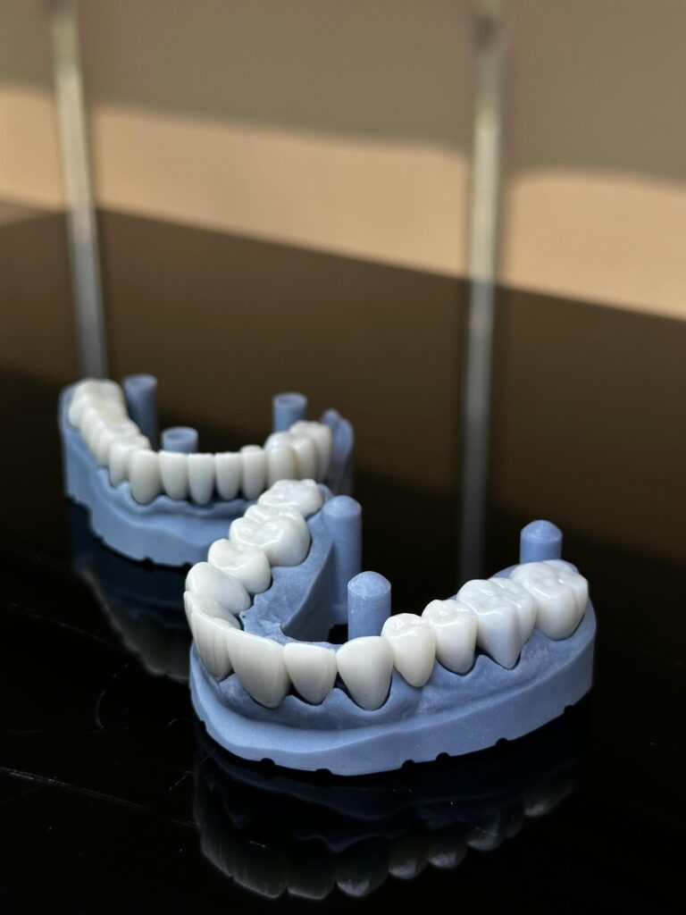 dental model showing full arch dental implant restoration with implants placed supporting fixed prosthetic teeth